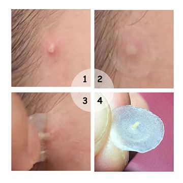 Лечебные патчи от акне, дневные 22 шт. / Acne treatment patches for day BREYLEE