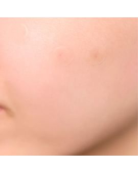 Тонкие патчи от прыщей SKIN1004 Tea-Trica Spot Cover Patch 22шт Тонкие патчи от прыщей SKIN1004 Tea-Trica Spot Cover Patch 22шт